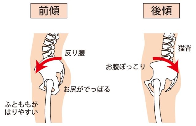 骨盤が歪む代表例