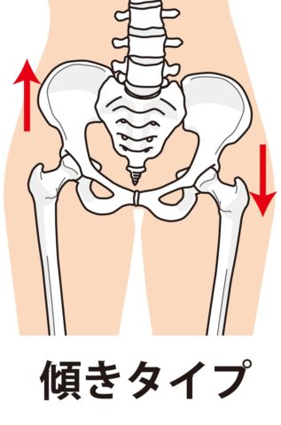 骨盤の傾き